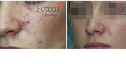 Фотона шлифовка рубцов 2